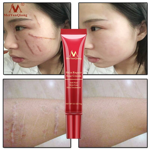 Hot sale Scar Repair Cream Skin Care Natural Acne Remove Burn Stretch Marks Scar Removal