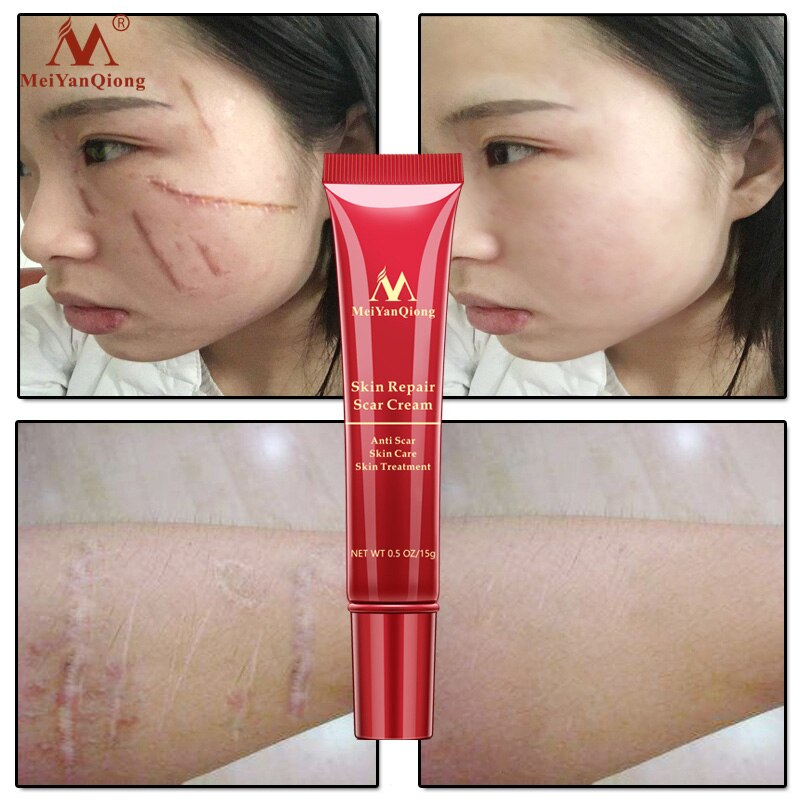 Hot sale Scar Repair Cream Skin Care Natural Acne Remove Burn Stretch Marks Scar Removal