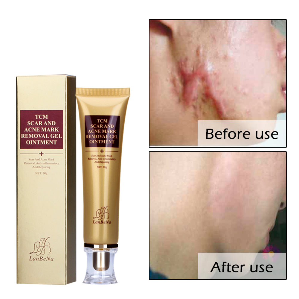 Acne Removal Facial Scar Repair Skin Cream Acne Spots Blackhead  Stretch Marks Whitening Treatment  Cream